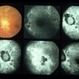 Eales Disease Eales Disease